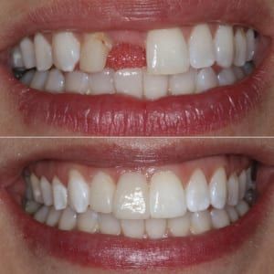 Dental Implants