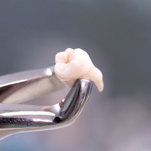 Tooth Extraction Tooth Extraction