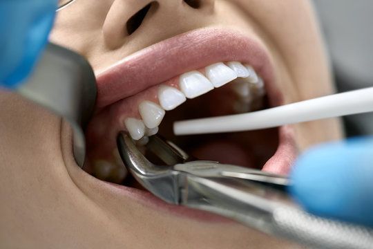 Emergency tooth extraction at Deluxe Dentistry serving Hamilton Township New Jersey