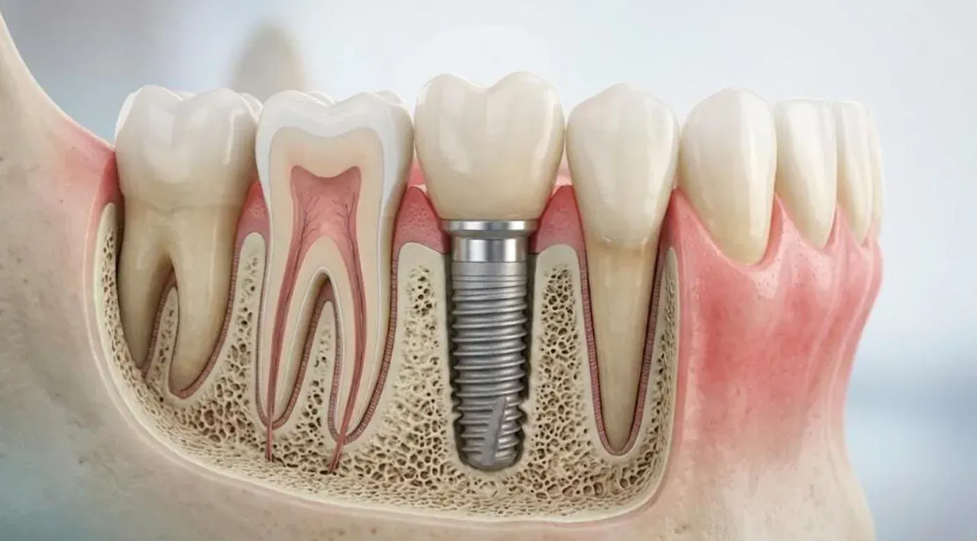 Ridge Splitting: a dental implant and crown in the jawbone beside natural teeth, shown in cross-section