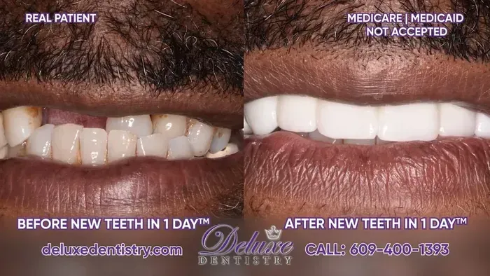 Kirby talking about his dental implants, with his before and after, for patients considering full arch dental implants