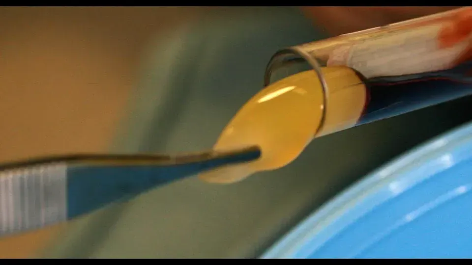 The platelet-rich fibrin (PRF) procedure, one of the oral surgery treatments shown in a Deluxe Dentistry & Esthetics video