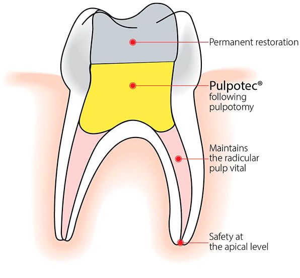 Pulpotomy Deluxe Dentistry