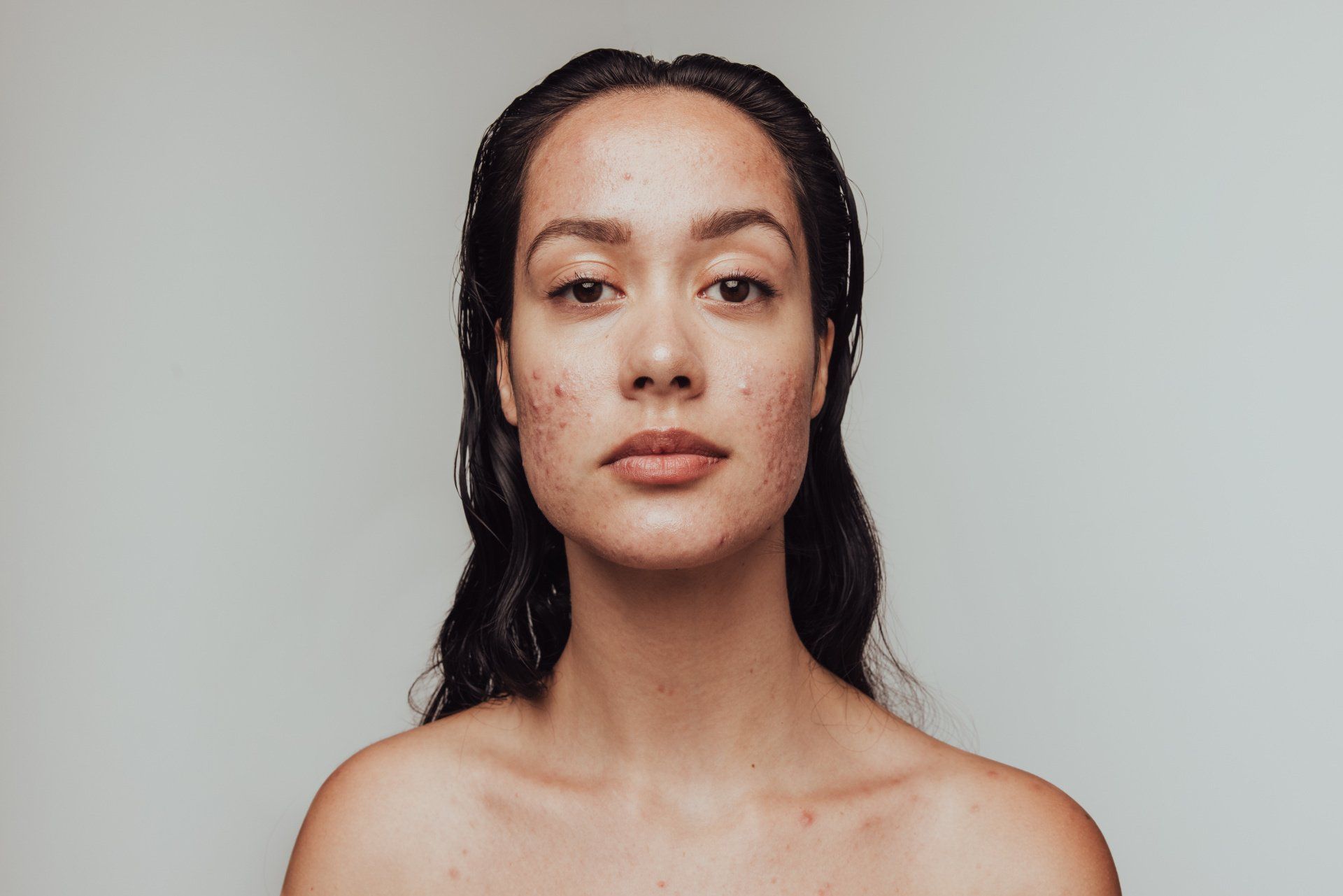 Acne scarring