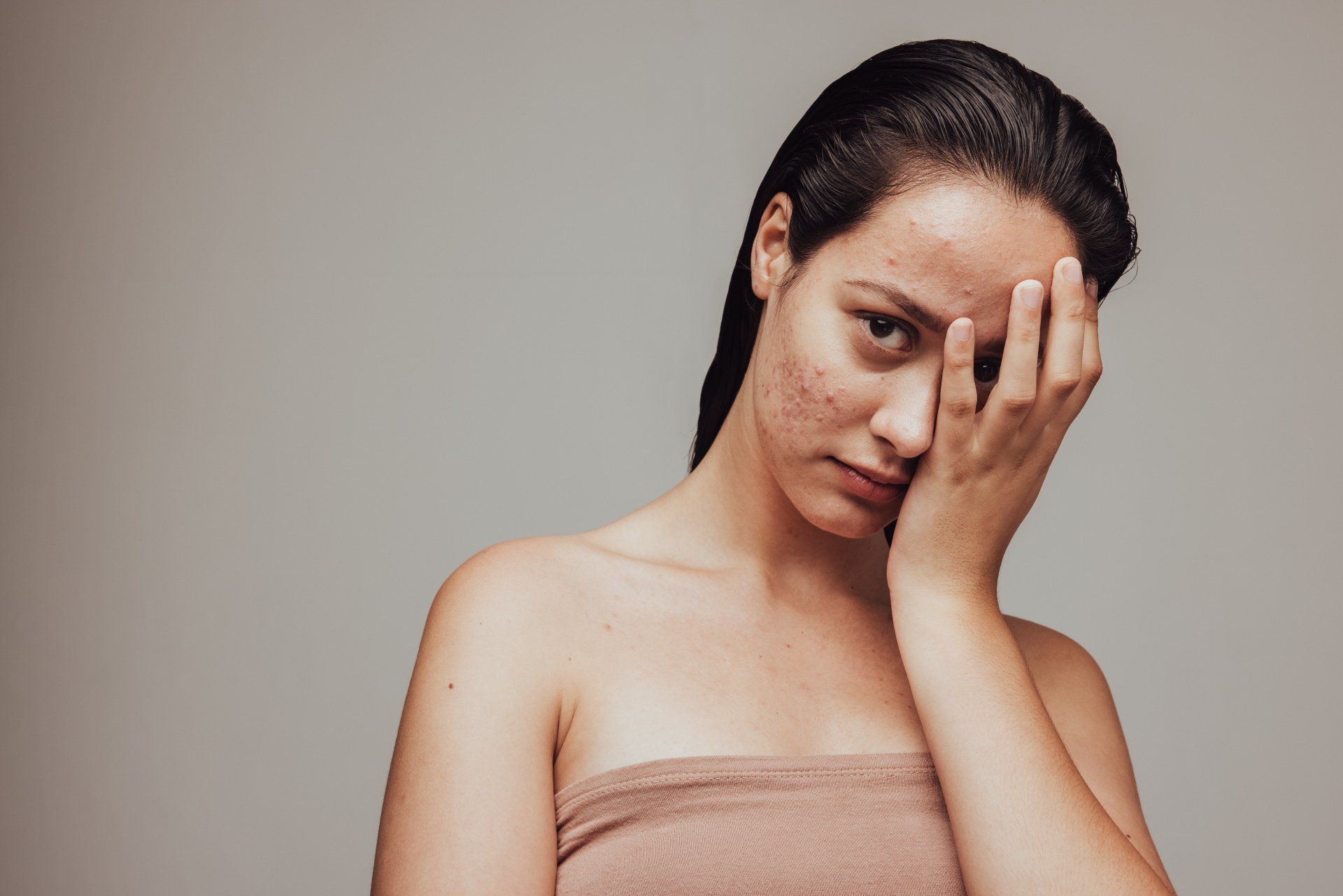 Why is my acne getting worse?