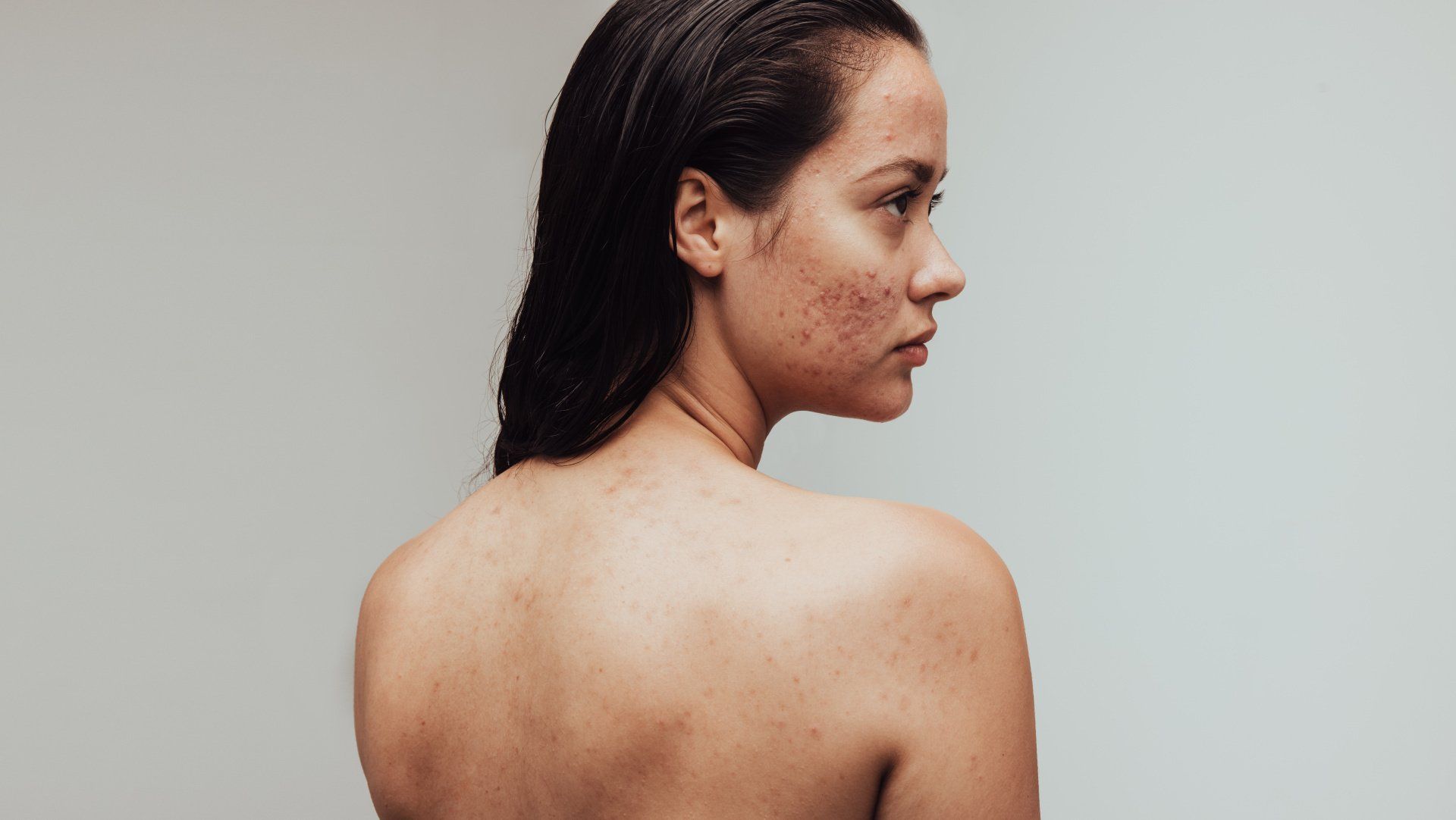Why do I get back acne?