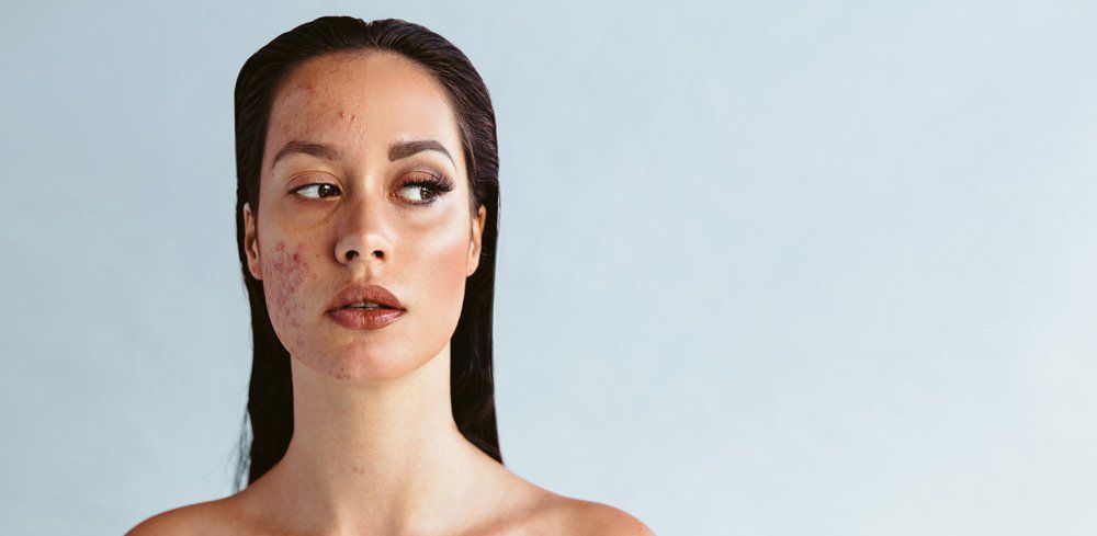 How to treat acne