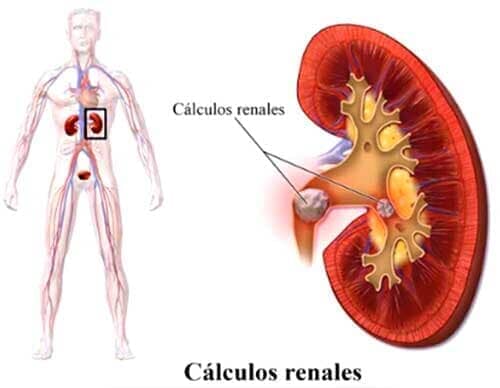 DR JUAN CARLOS AGUILAR IÑIGUEZ – CÁLCULOS RENALES