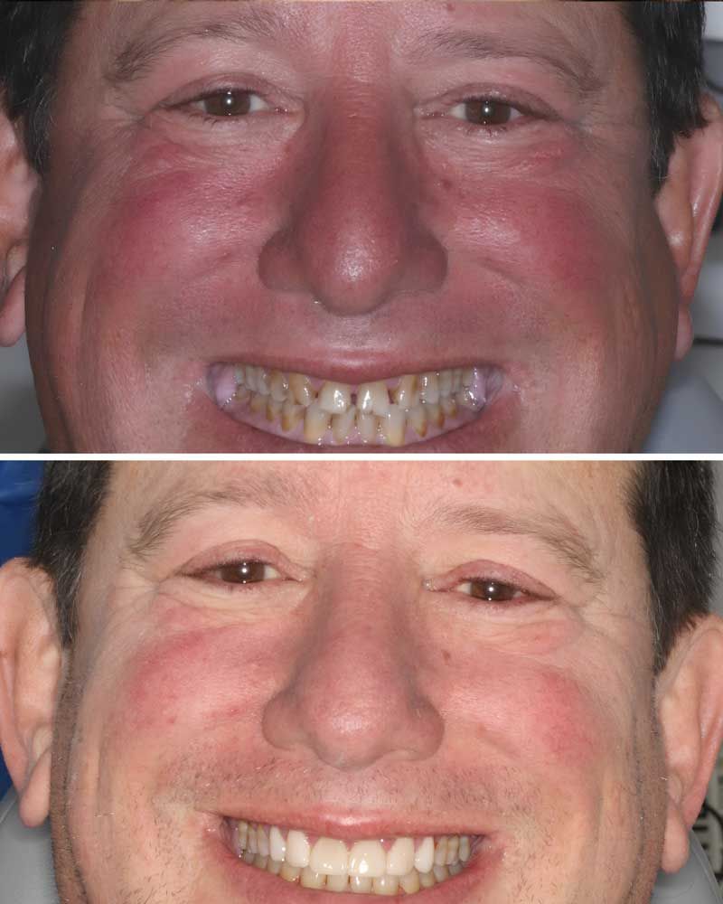Before & After - Brian Bandler