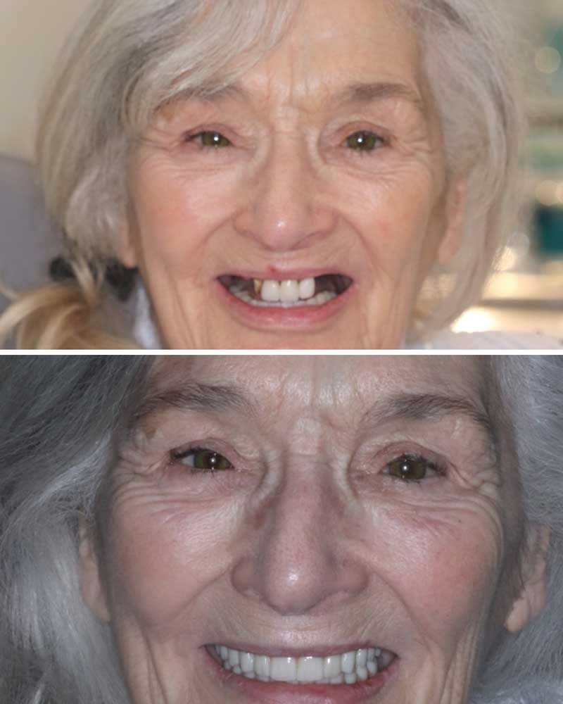Before & After - Elaine Hevenor