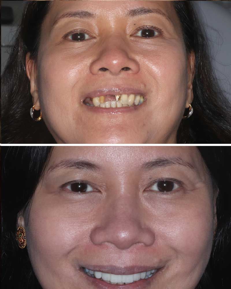 Before & After - Generose Gutirrez