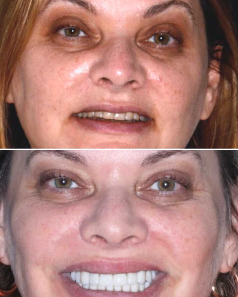 Before & After - Inna Vaysman