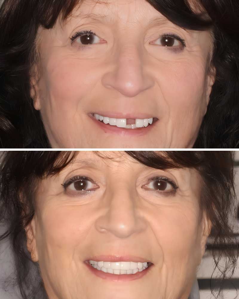 Before & After - Joan Pepe