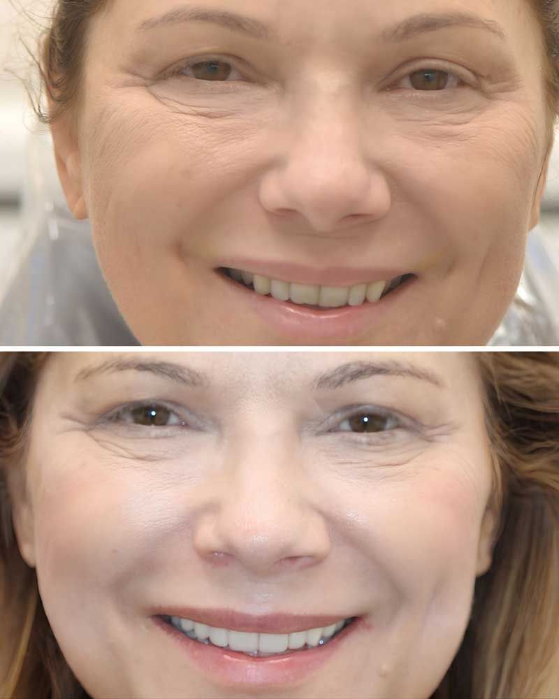 Before & After - Lamis Olsen