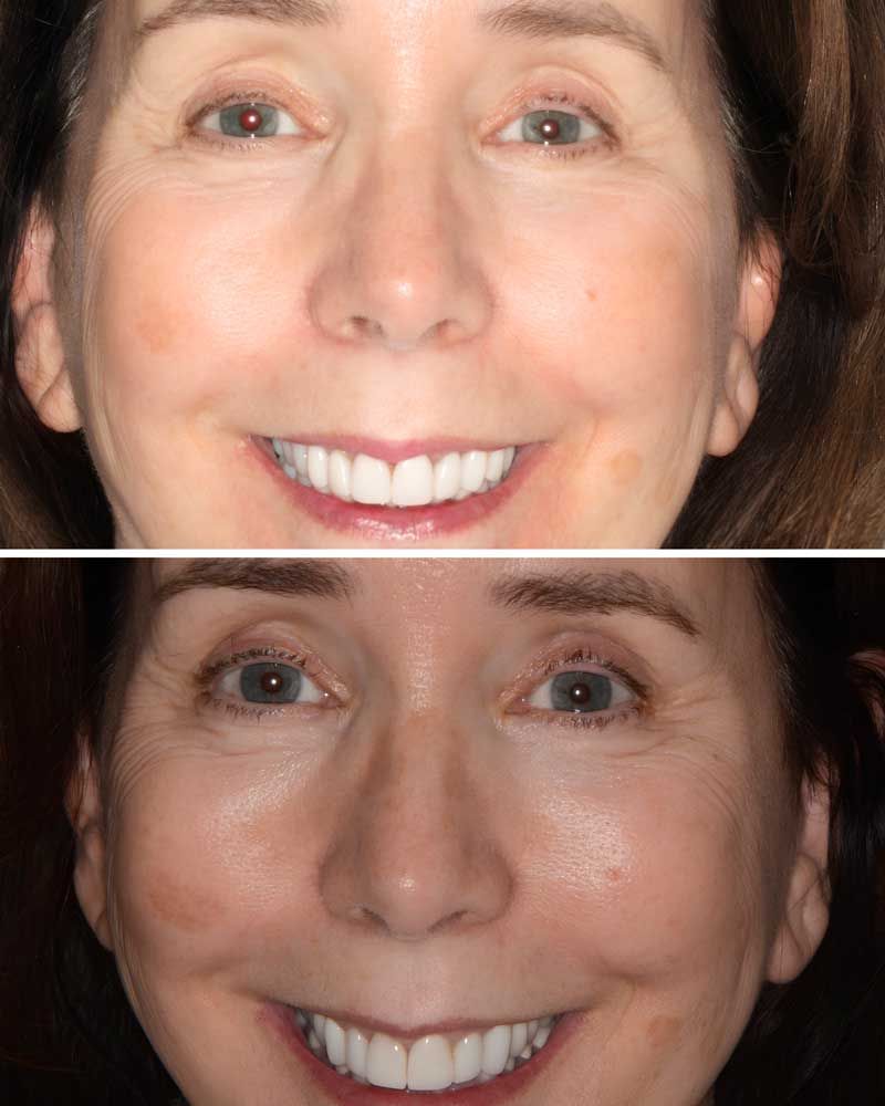 Before & After - Nancy Pron