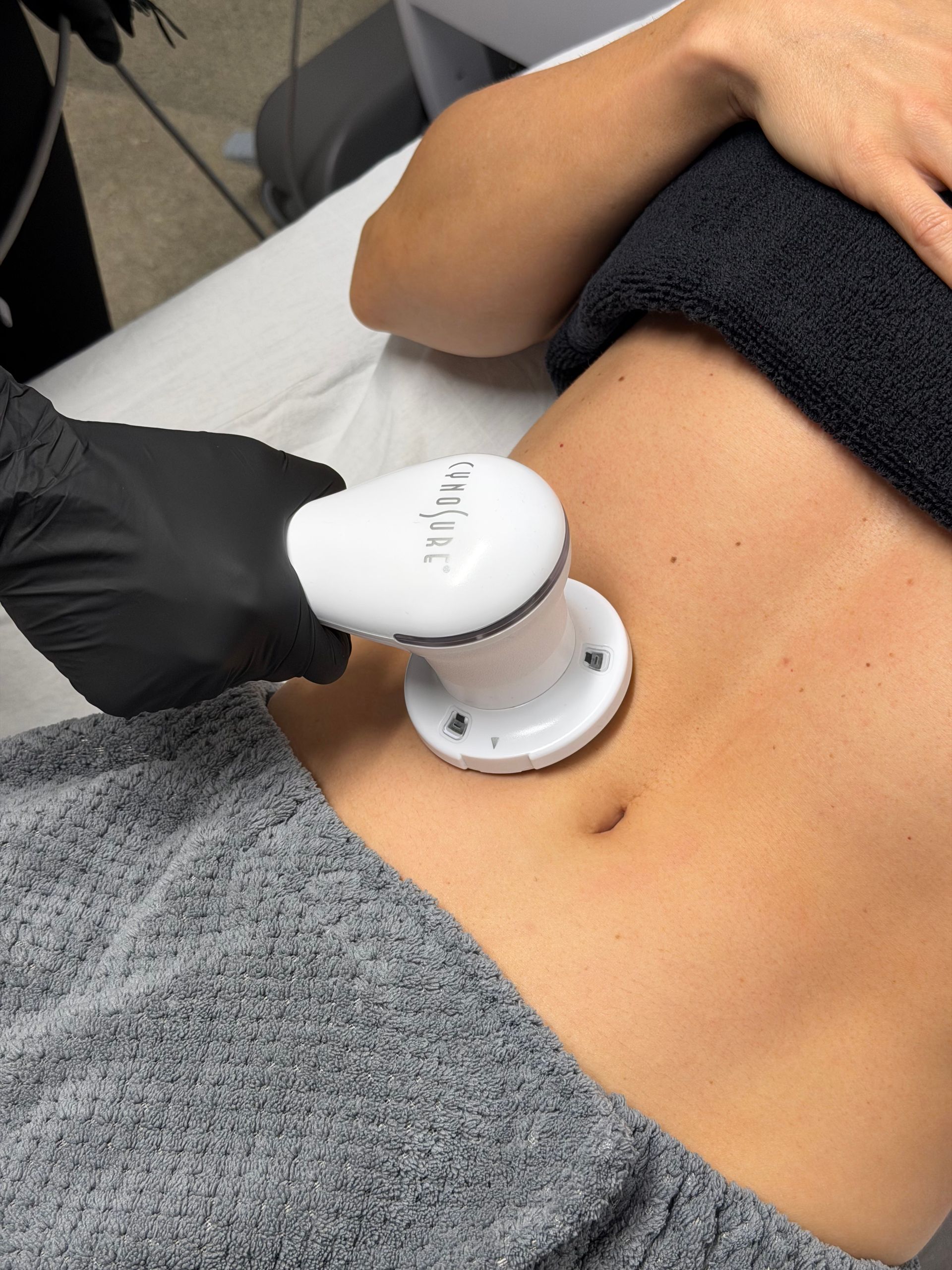 cellulite treatment huntington beach