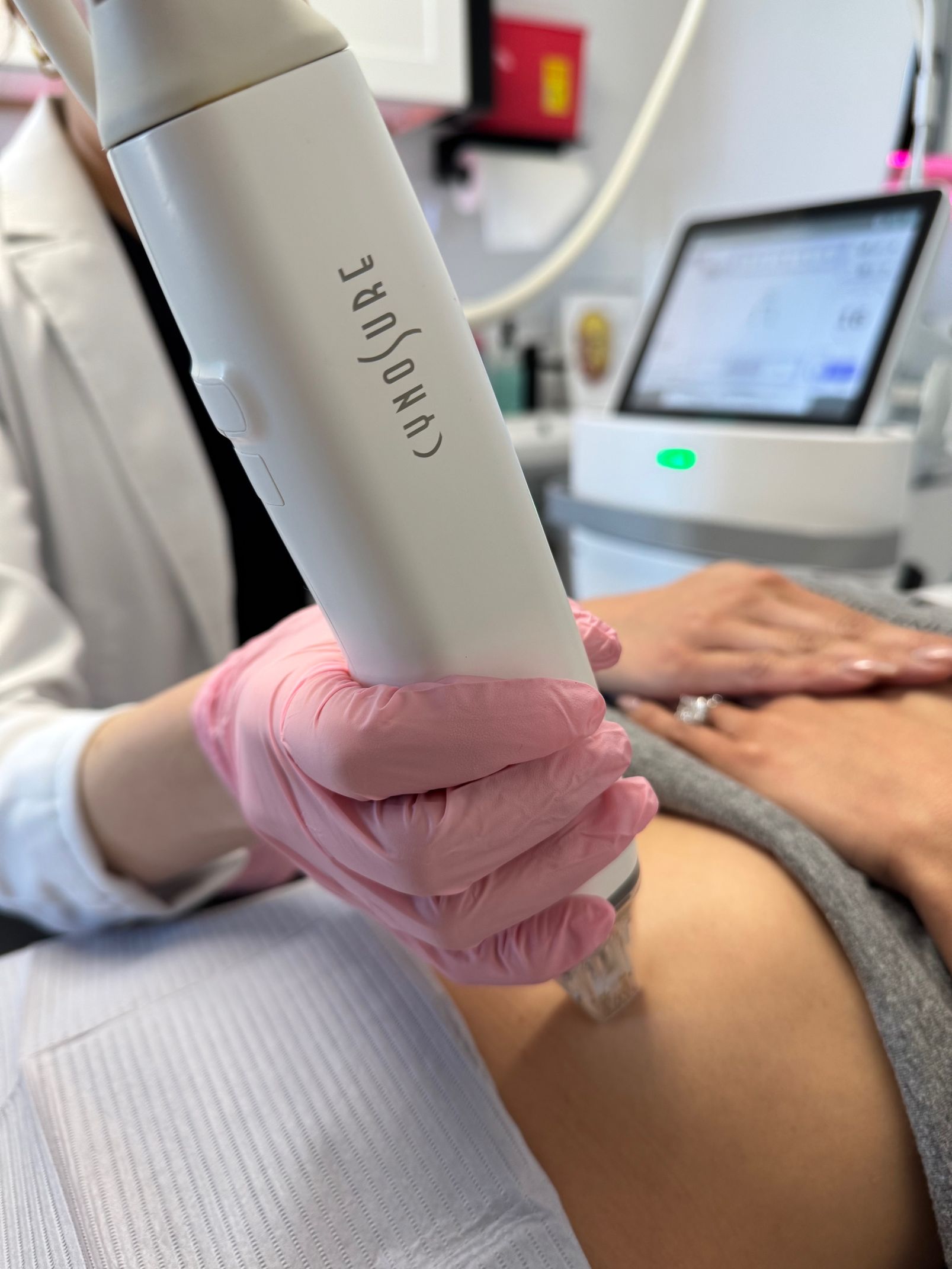 A woman is getting a RF microneedling treatment at a med spa in huntington beach