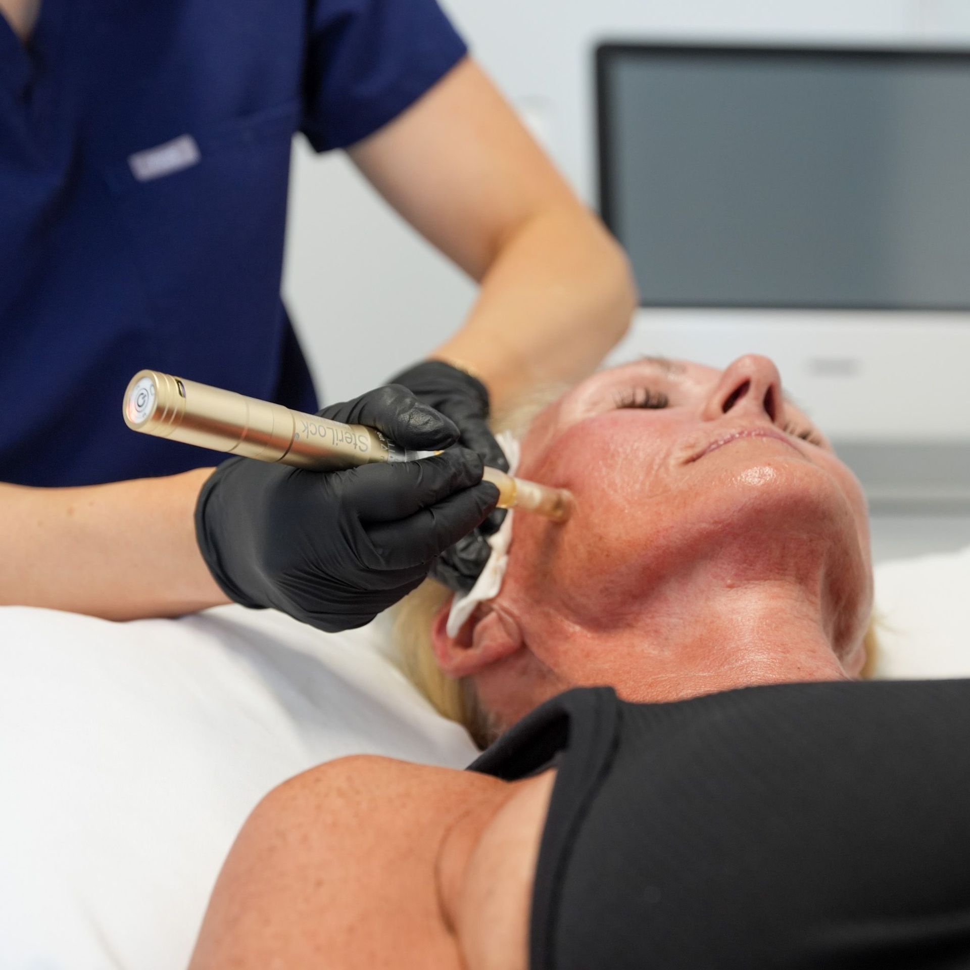 microneedling in huntington beach