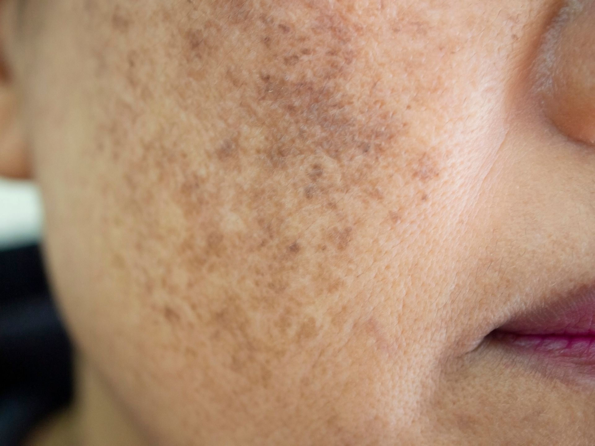 Close-up of a cheek with dark freckles and a partially visible lip