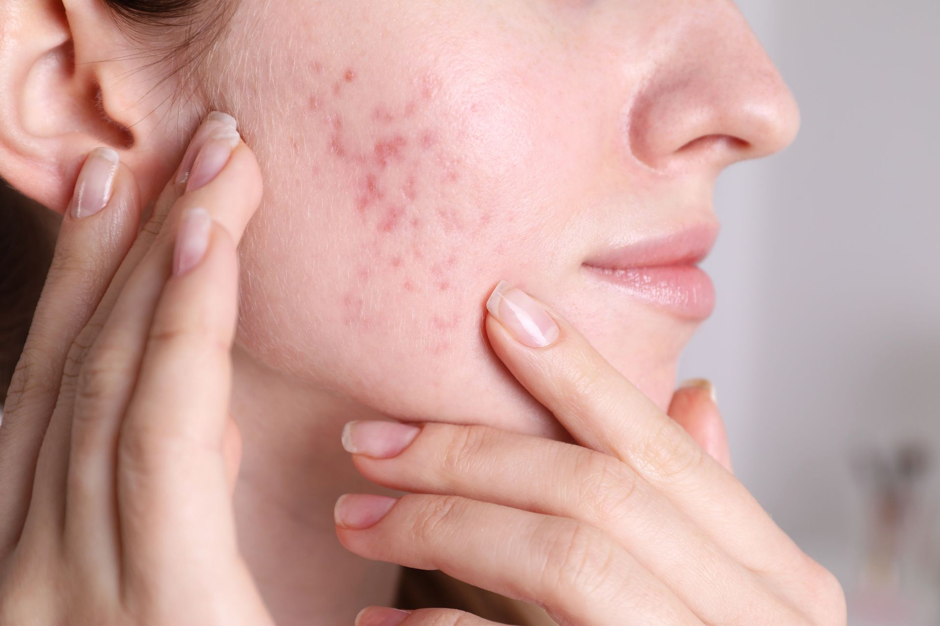Close-up of a cheek with dark freckled pigmentation and a partially visible lip