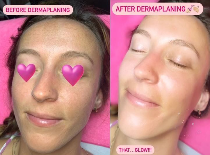 A woman 's face is shown before and after dermaplaning.