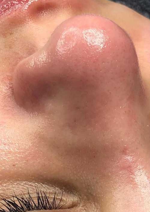 a clean nose showing black head removal after