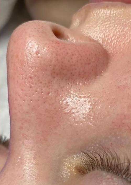 black heads treatment after picture