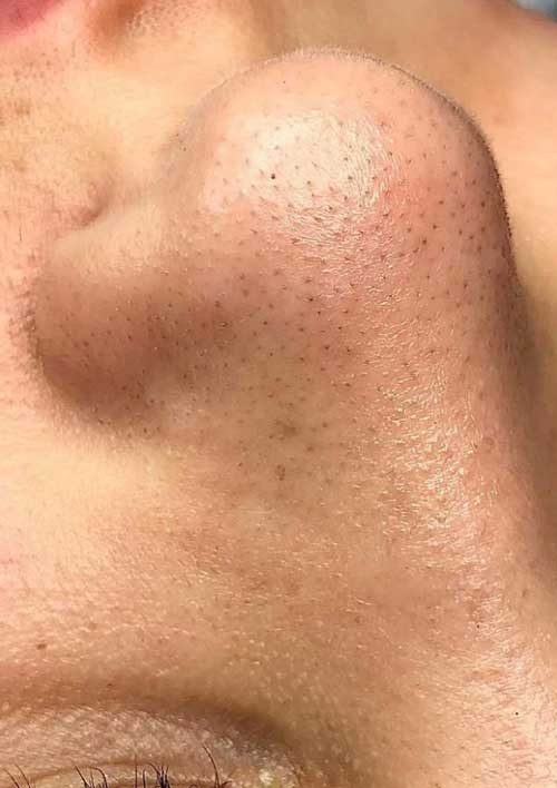 black heads on nose showing before 