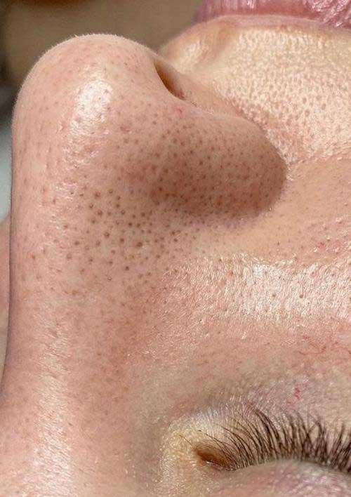 deep facial black heads before treatment picture