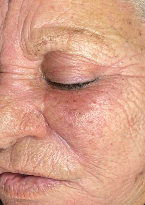 hard peeling of anti-aging after treatment picture of an old lady