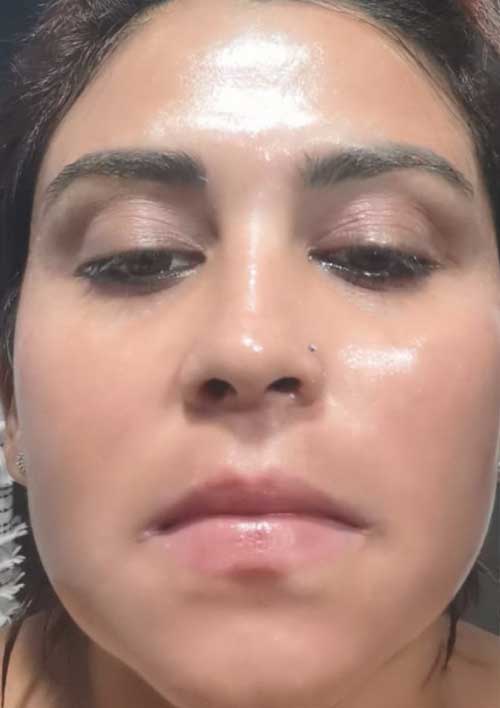 hard pigmentation removal after treatment picture