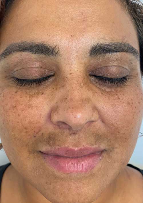 hard pigmentation removal before treatment picture