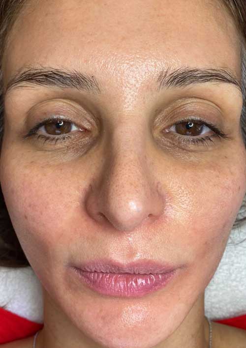 pigmentation after treatment, a clear skin