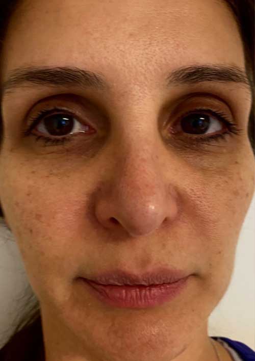 pigmentation before treatment, skin with marks and dullness