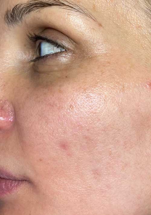 pigmentation after results