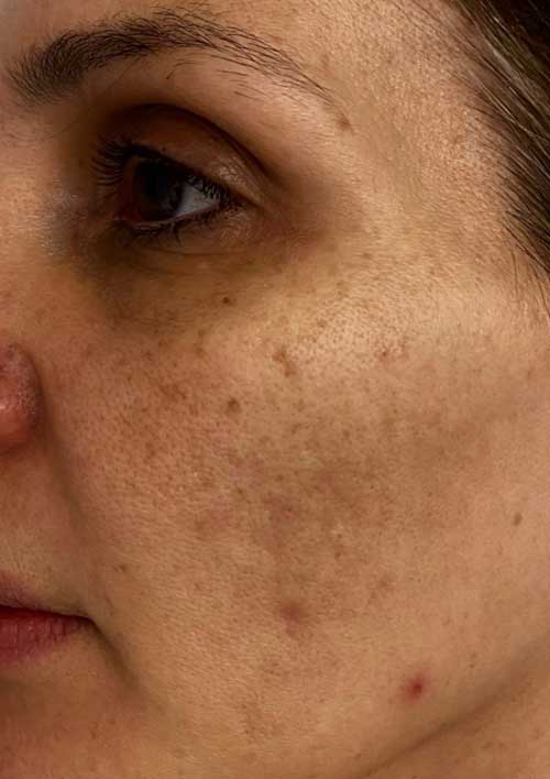 pigmentation before 