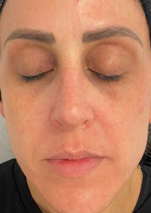 pigmentation after treatment