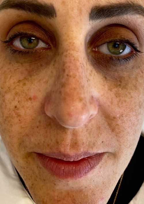 pigmentation before