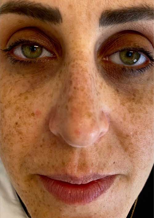 pigmentation before