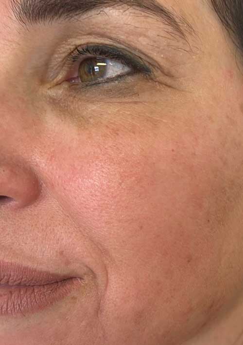 pigmentation of middle aged woman
