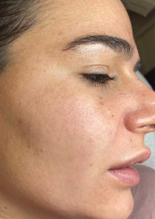 pigmentation and sun spots after the treatment