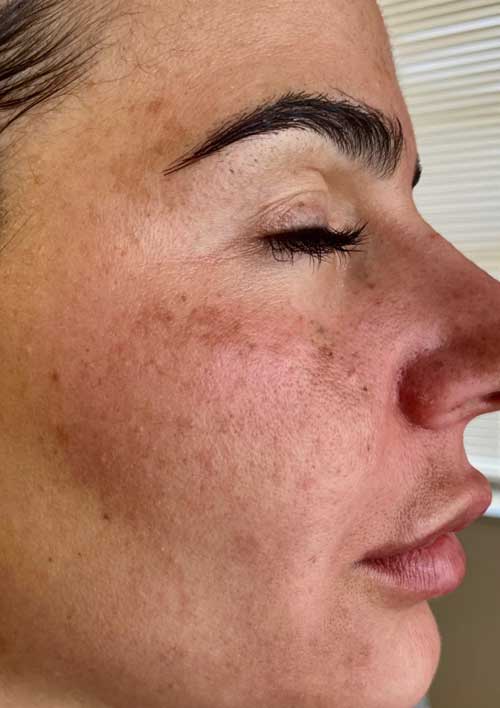 pigmentation and sun spots before the treatment