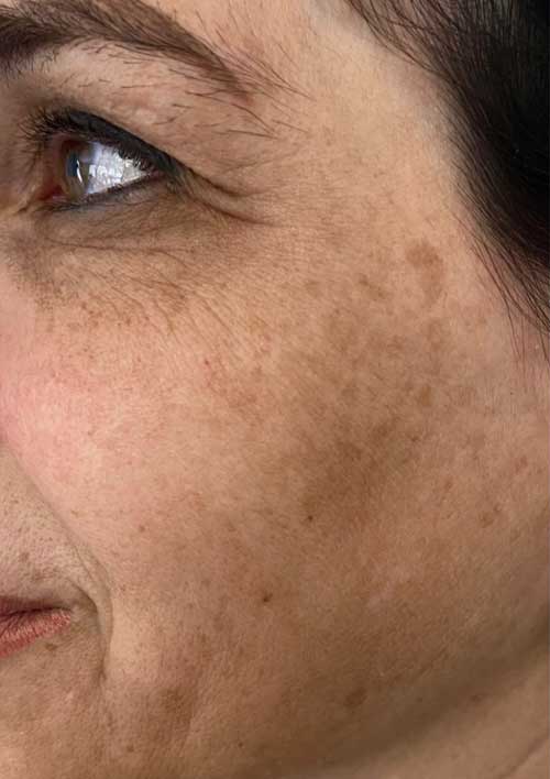 pigmentation of a middle-aged woman showed in the picture