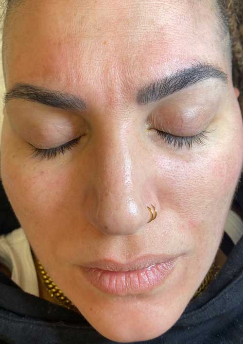 pigmentation after treatment skin
