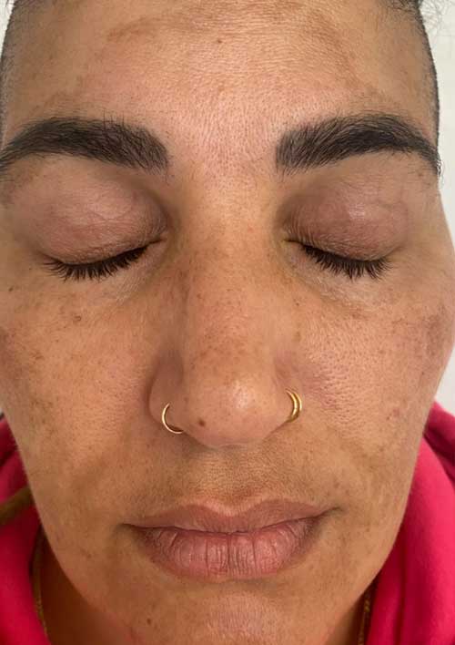 pigmentation before treatment skin