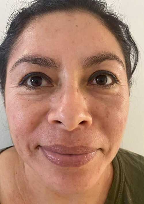 pigmentation with active acne after treatment, a woman face with clear skin