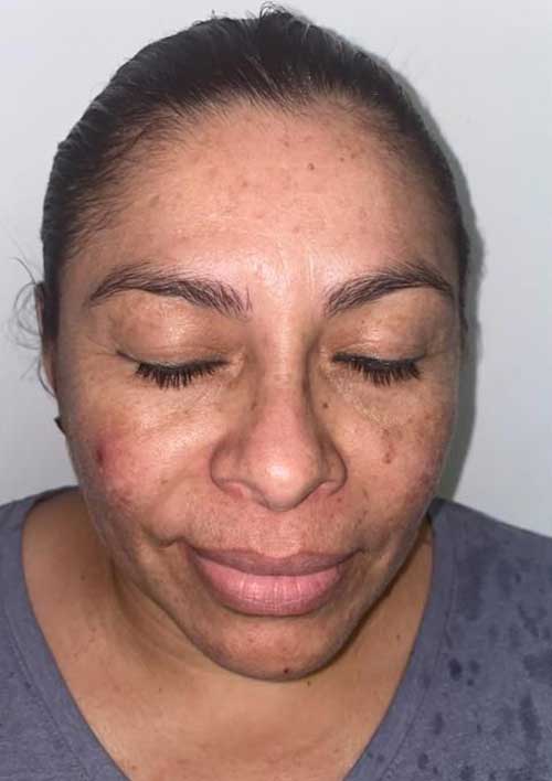 pigmentation with active acne before treatment