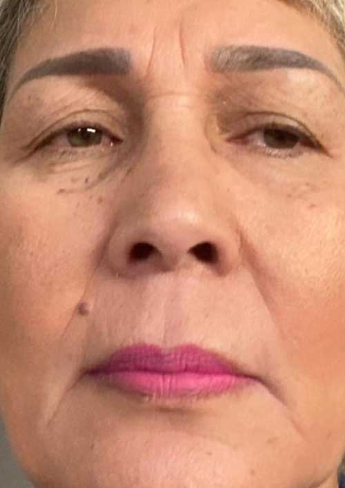 pigmentation and wrinkles after treatmen