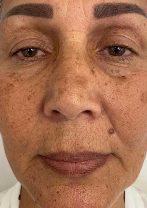pigmentation and wrinkles before treatment