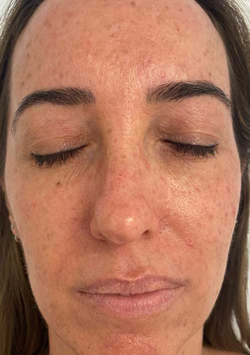 pigmentation after